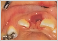 外傷歯の脱落への対応